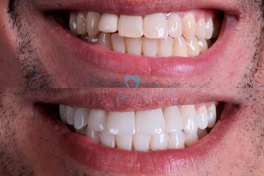 clareamento dental