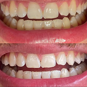Guia Completo: Clareamento Dental Caseiro para Noivos