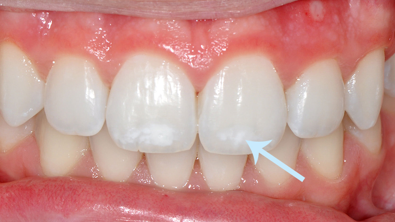 Clareamento a Laser vs. Clareamento Caseiro: Qual o Melhor para o seu Casamento?