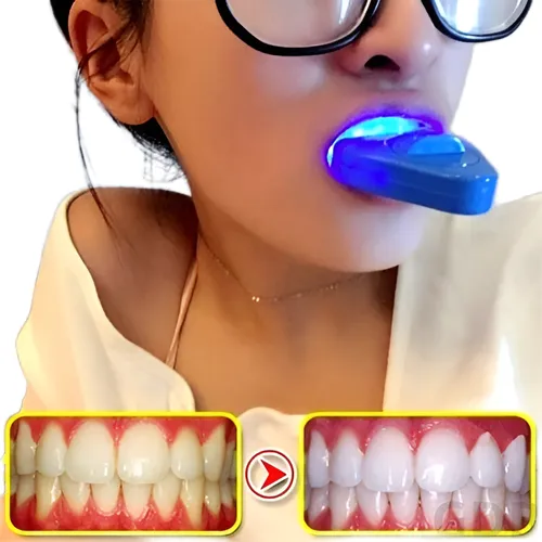 Pacotes de Clareamento Dental para Casais: Vale a Pena Investir?